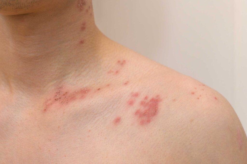 5 Alasan Mengapa Lansia Dianjurkan Mendapatkan Vaksin Herpes Zoster